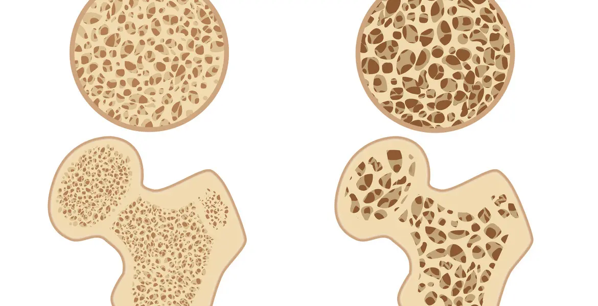 que-es-la-osteoporosis-y-como-prevenirla_banner